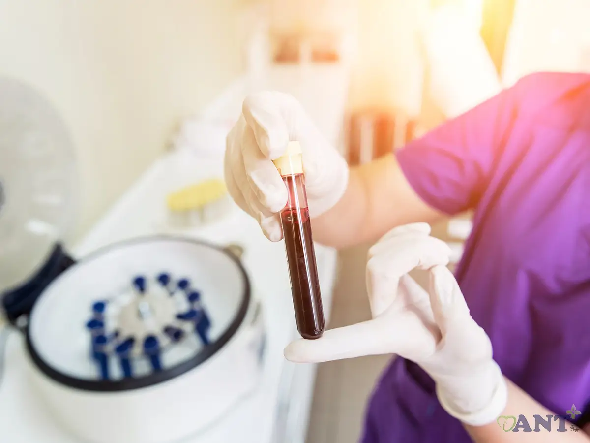 تقویت رشد مو با پلاکت درمانی